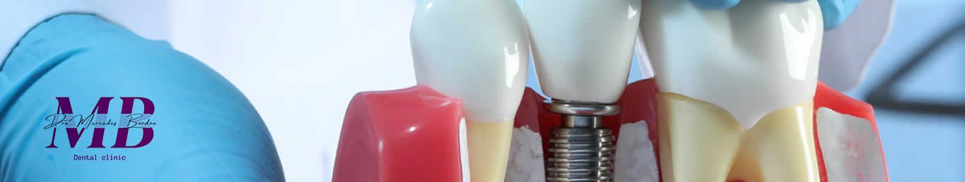 Implantes Dentales