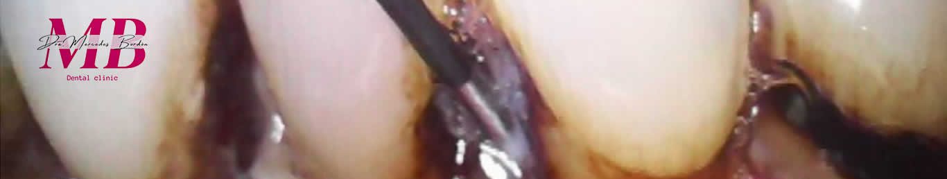 Periodoncia