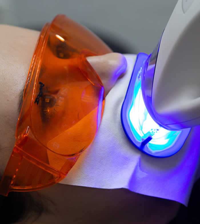 Blanqueamiento dental con luz LED