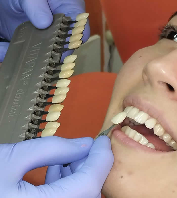 Guía de color dental