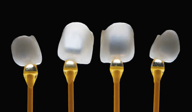 Carillas dentales de porcelana