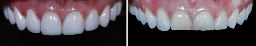 Sonrisa antes y después de carillas dentales