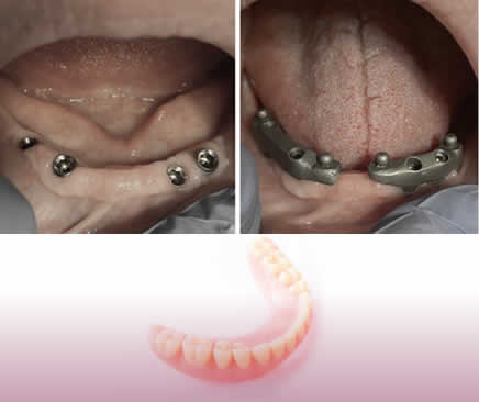 Rehabilitación sobre implantes