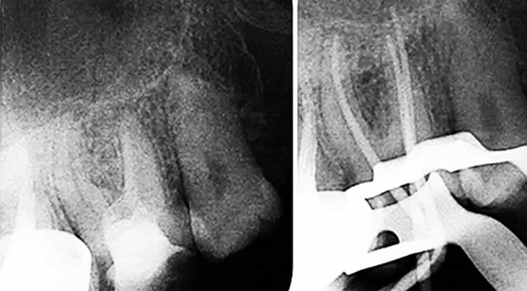 Radiografías de un tratamiento de endodoncia
