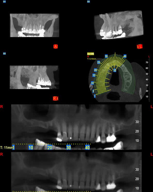 Estudio tomográfico para planificar implantes