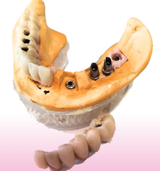 Prótesis sobre implantes
