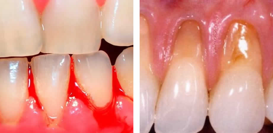 Gingivitis: encías enrojecidas