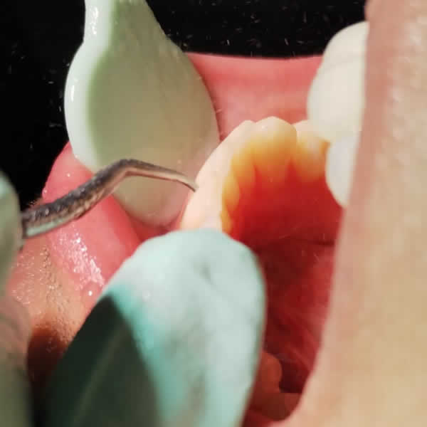 Limpieza dental profesional