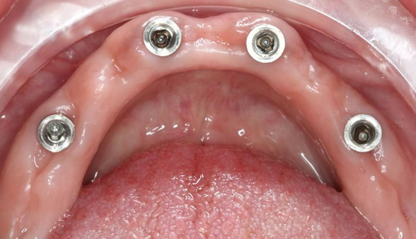 Prótesis sobre implantes